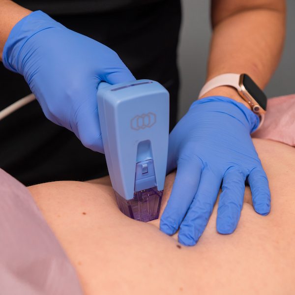 Morpheus8 specialists Canton MI performing stomach Morpheus8 treatment body