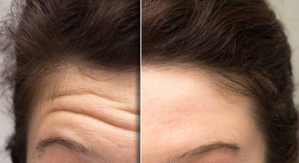 Wrinkle-relaxing injection treatment at Ever Medical Spa in Canton, MI