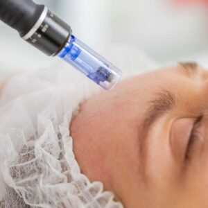 best microneedling hyaluronic acid best skin treatment for fine lines, acne scars, dark spots