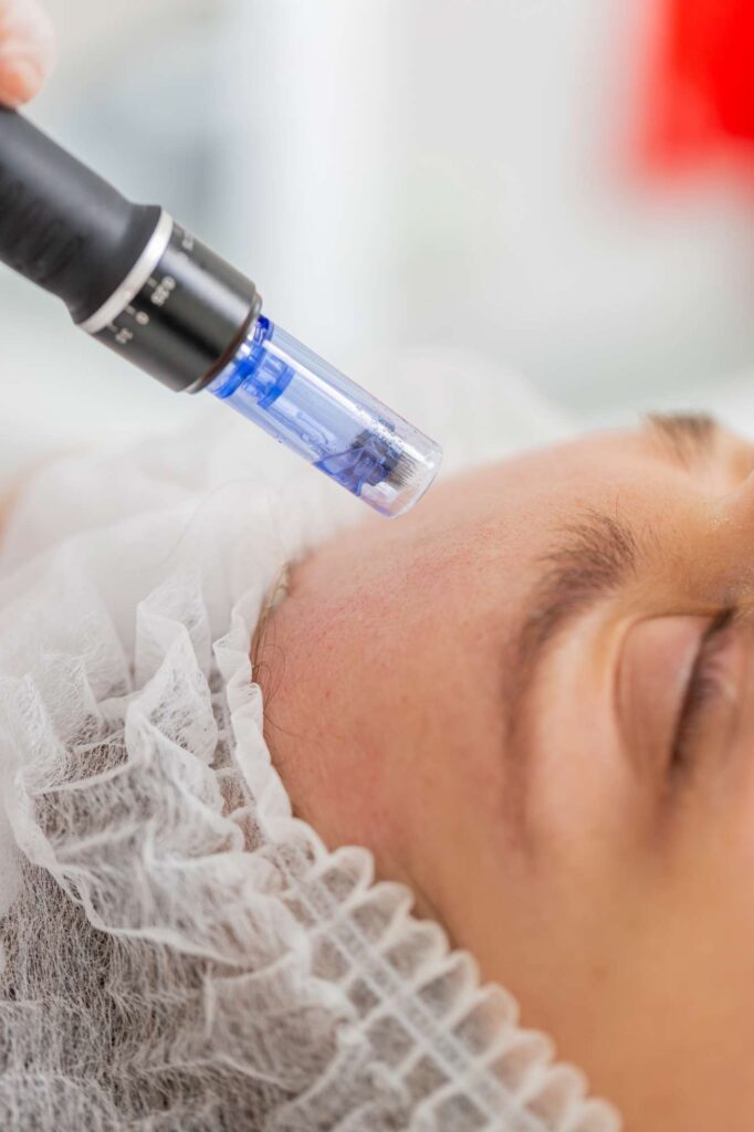 best microneedling hyaluronic acid best skin treatment for fine lines, acne scars, dark spots