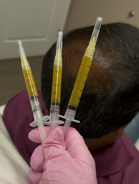 PRP Hair treatment