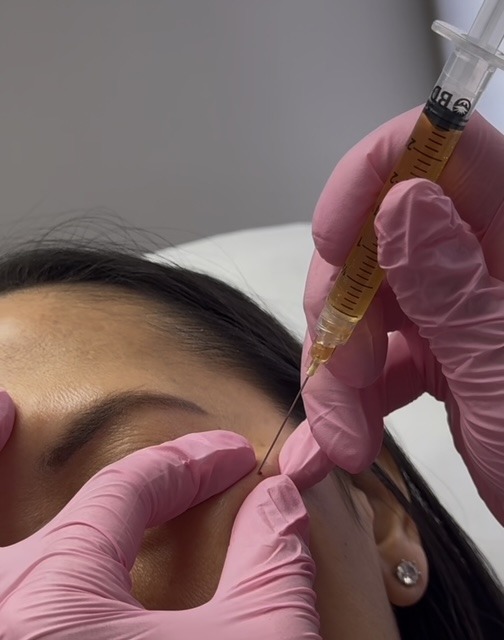 Undereye PRP injcetion treatment in Canton MI