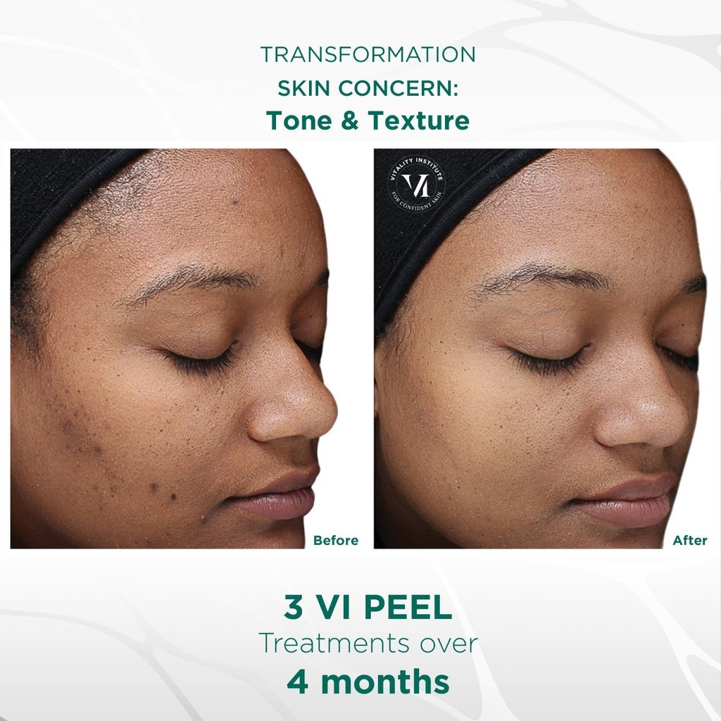 Before and after chemical peel treatment at EVER Medical Spa in Canton, Michigan for brighter, smoother skin