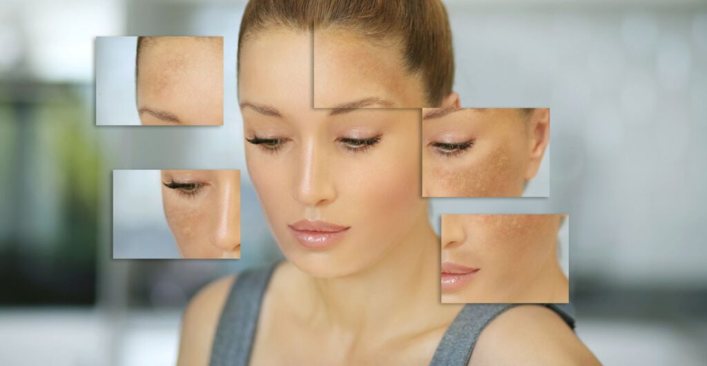melasma hyperpigmentation specialist