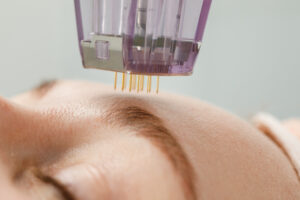 Morpheus8 specialists Canton MI performing Morpheus8 treatment face