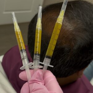 Provider performing PRP or PRF scalp injections for hair restoration at Ever Medical Spa in Canton, Michigan